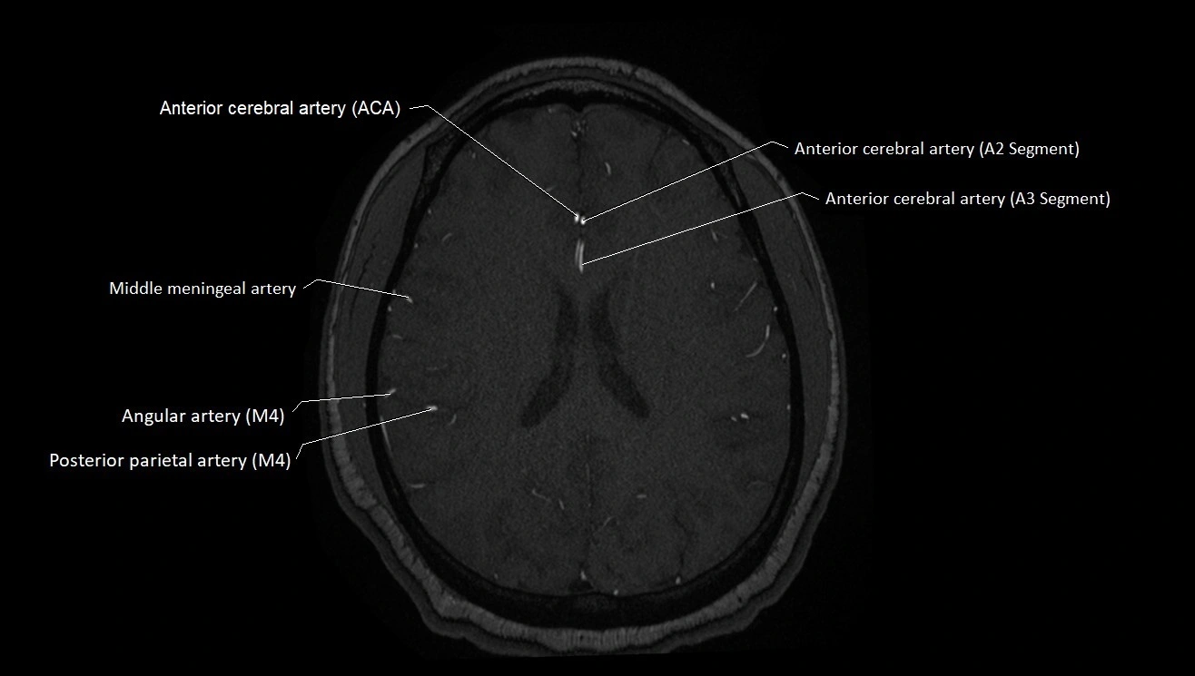 MRA brain (cerebral arteries) anatomy axial 3T image 38.webp